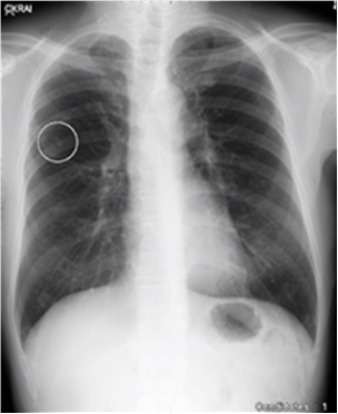 胸部X線画像の判定にAI技術を導入